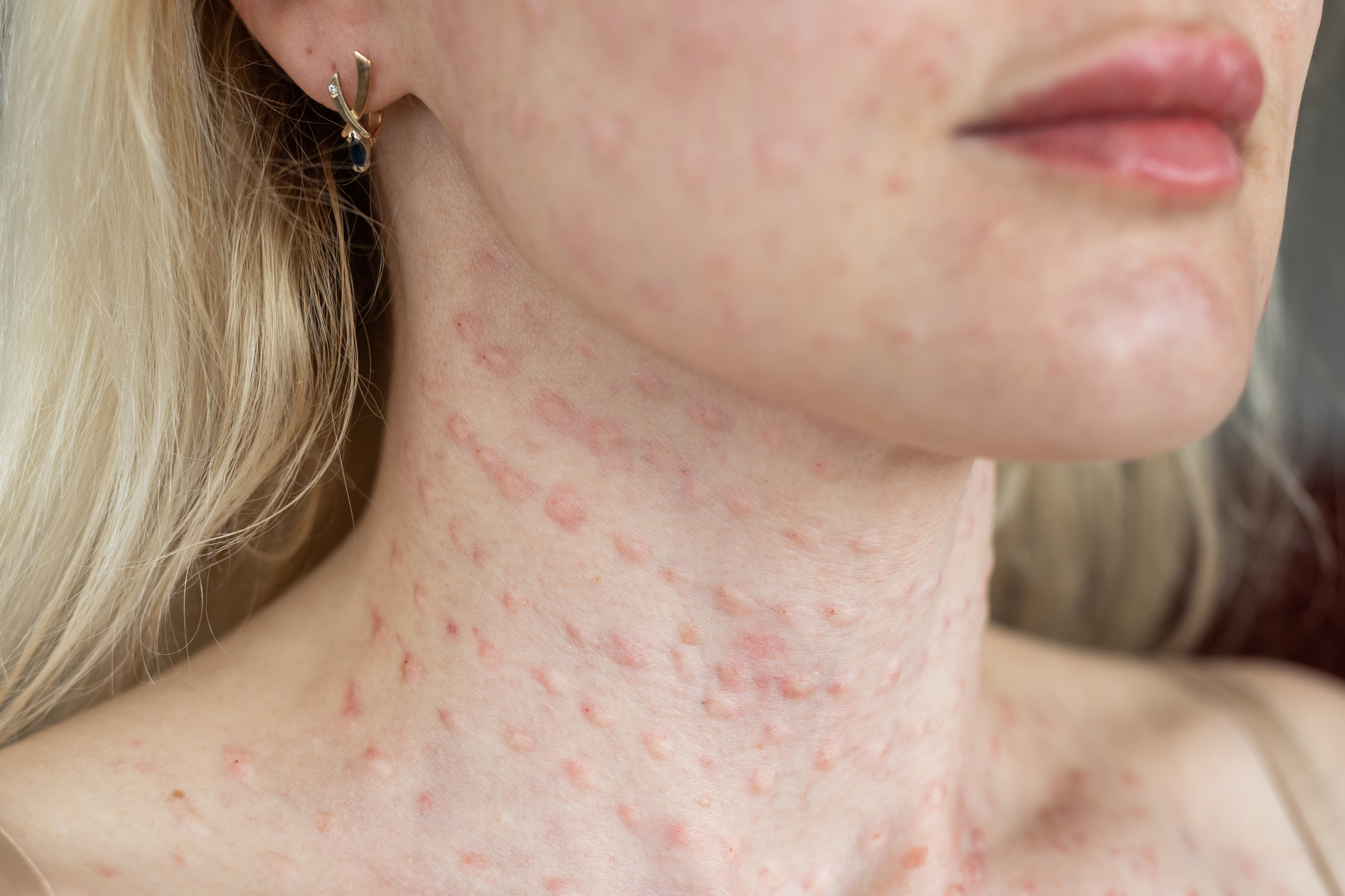 3. الشرى (Hives)