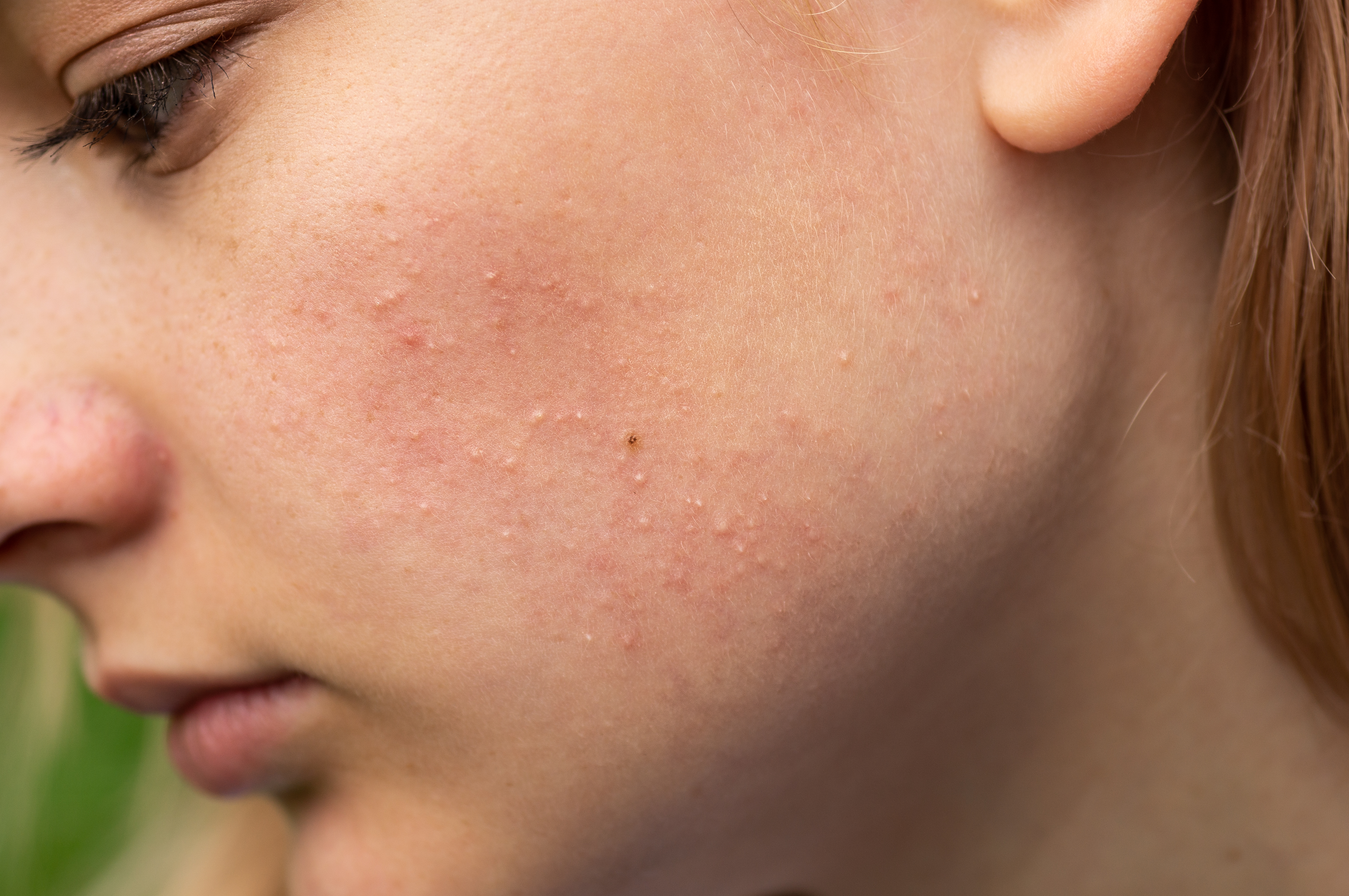 2. التهاب الجلد التماسي (Contact dermatitis)