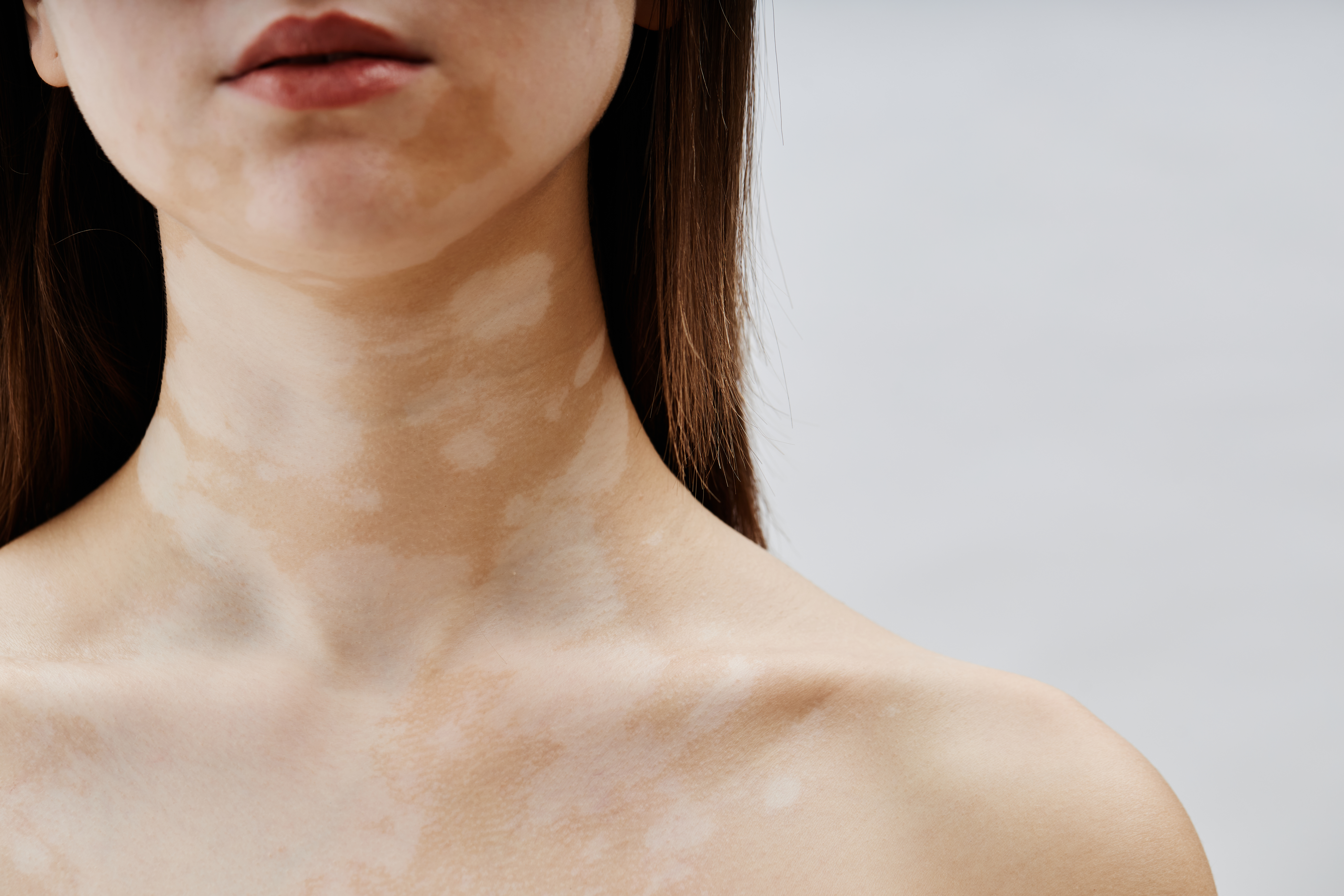 أعراض أخرى تُصاحب البهاق