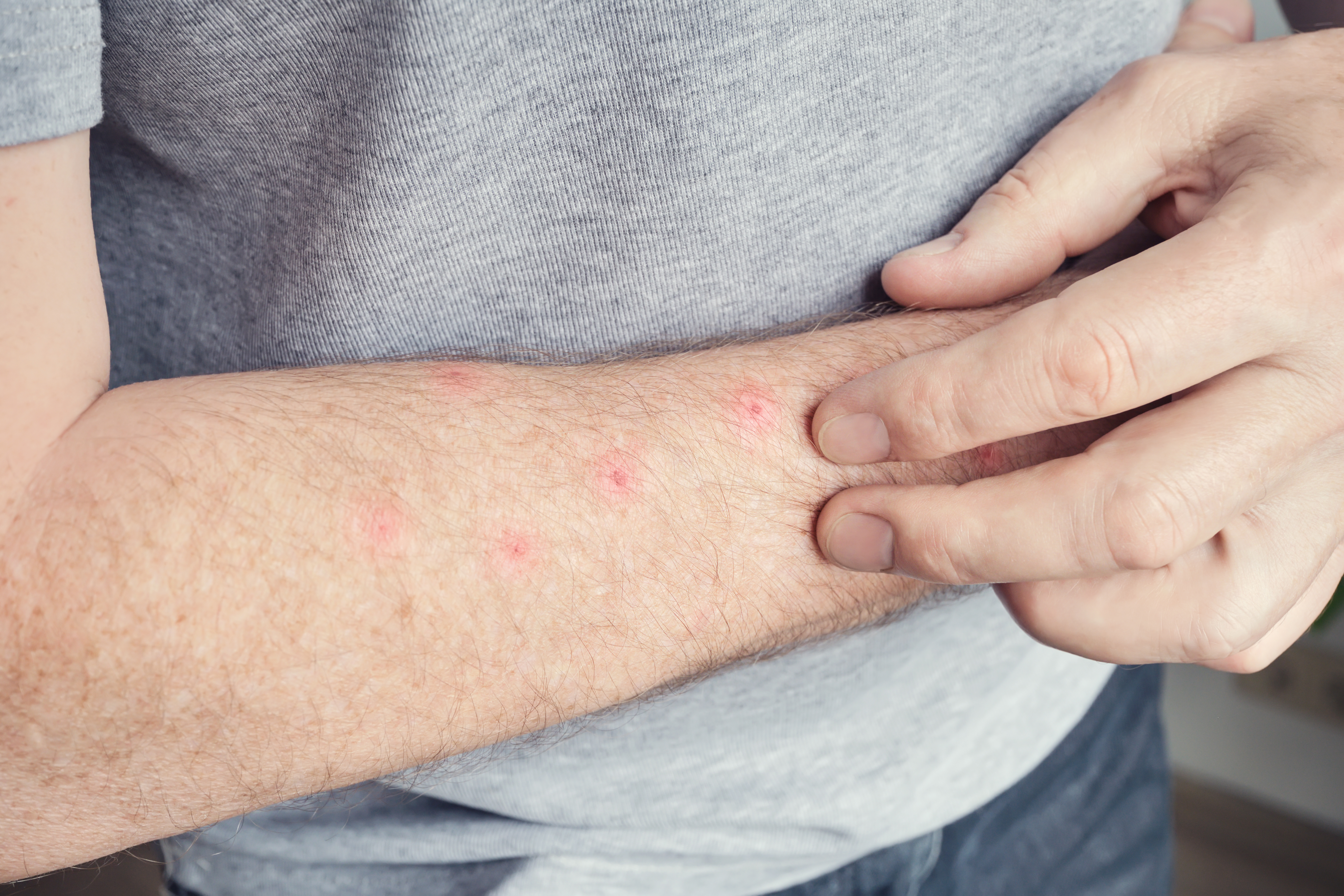 7. الجرب (Scabies)