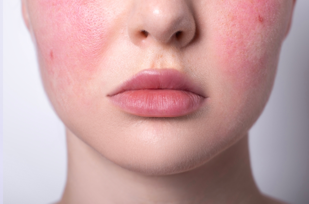 5. الوردية (Rosacea)