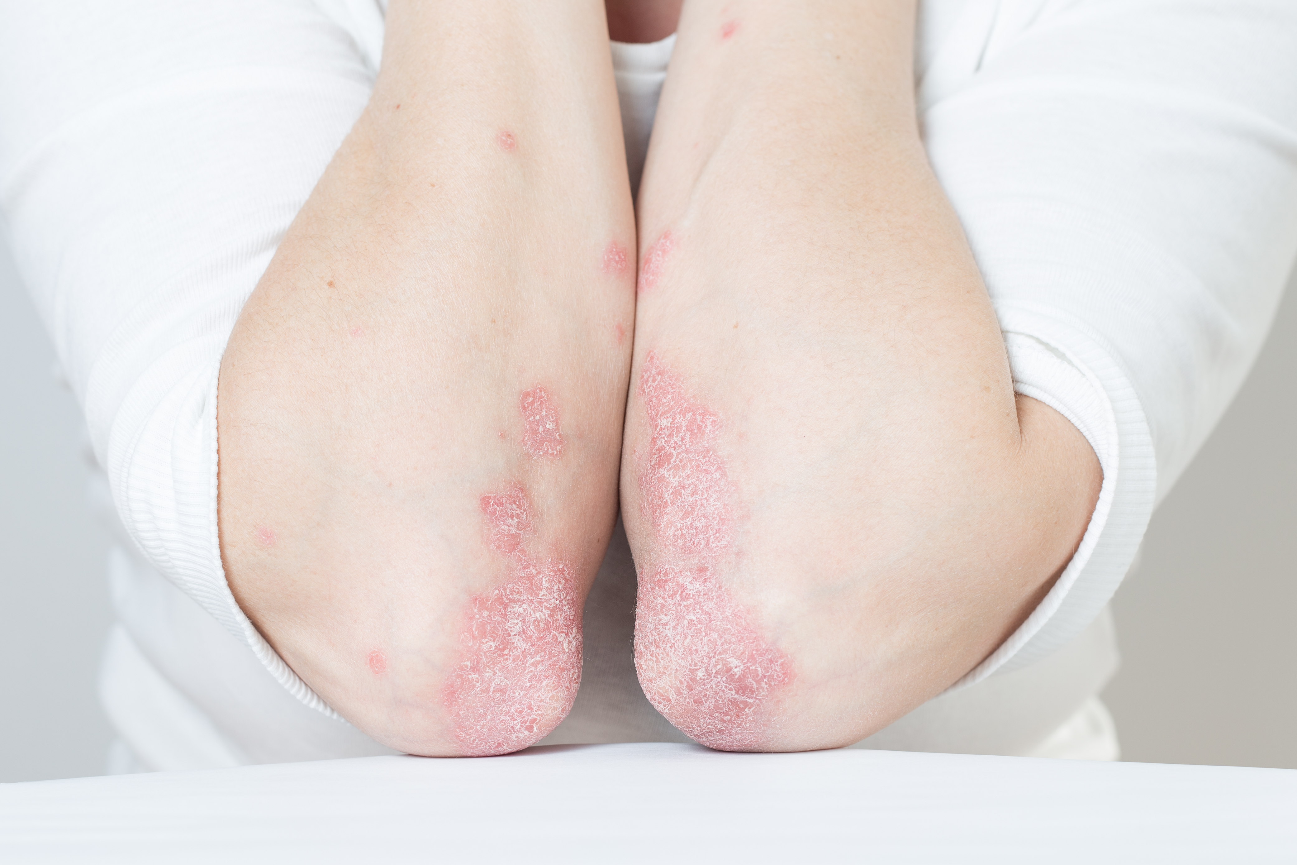 4. الصدفيّة (Psoriasis)