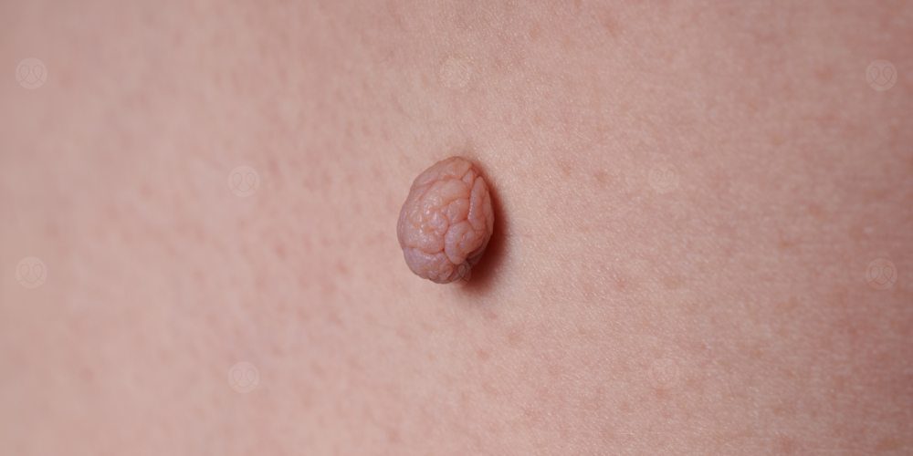 زوائد جلدية تحت الابط