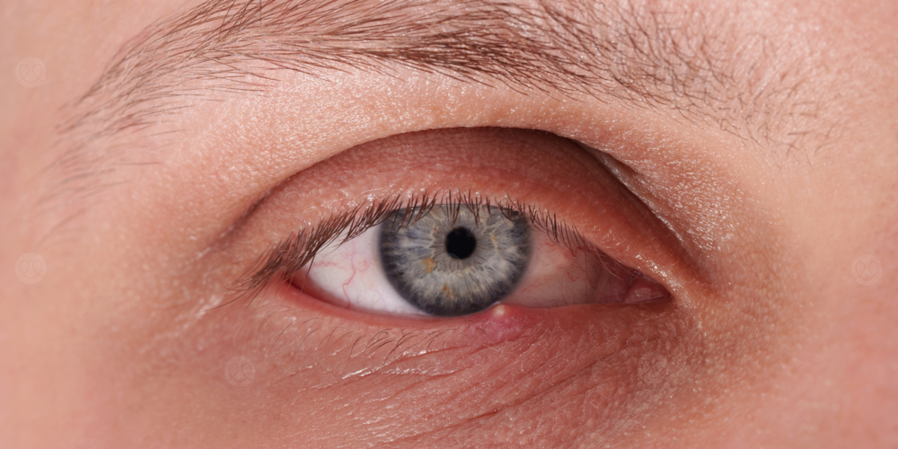 الكيس الدهني في العين