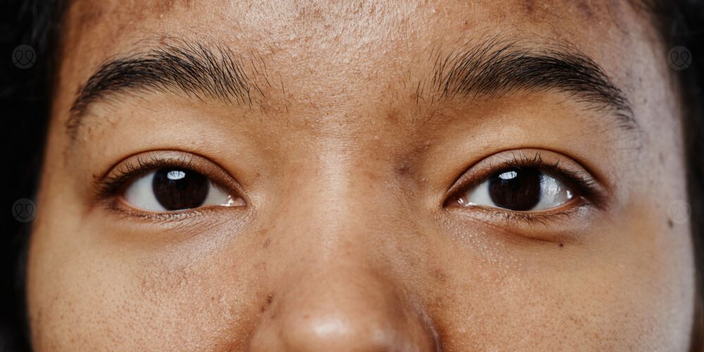 بقع بنية على الجلد بدون حكة عند الاطفال