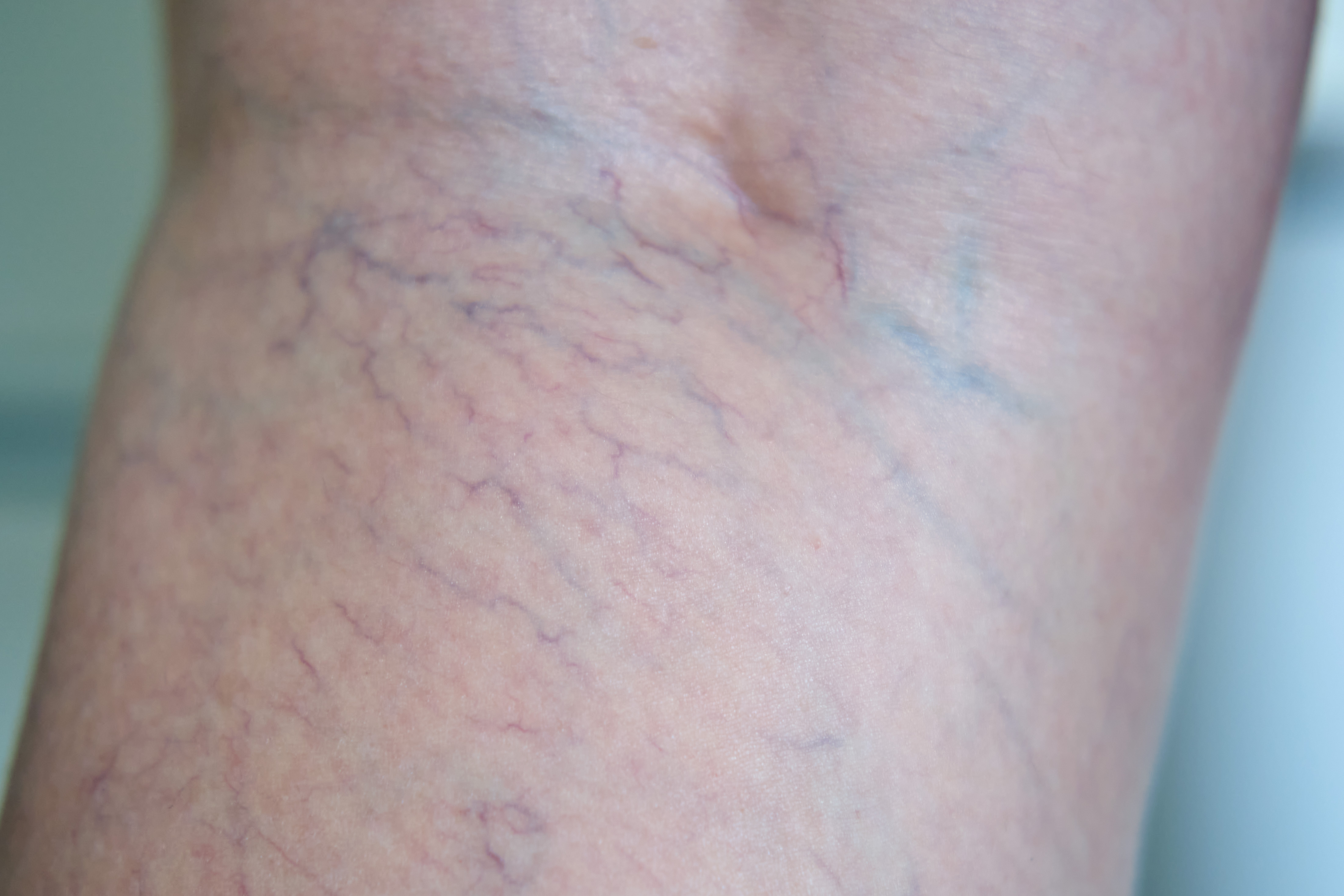 أعراض الدوالي