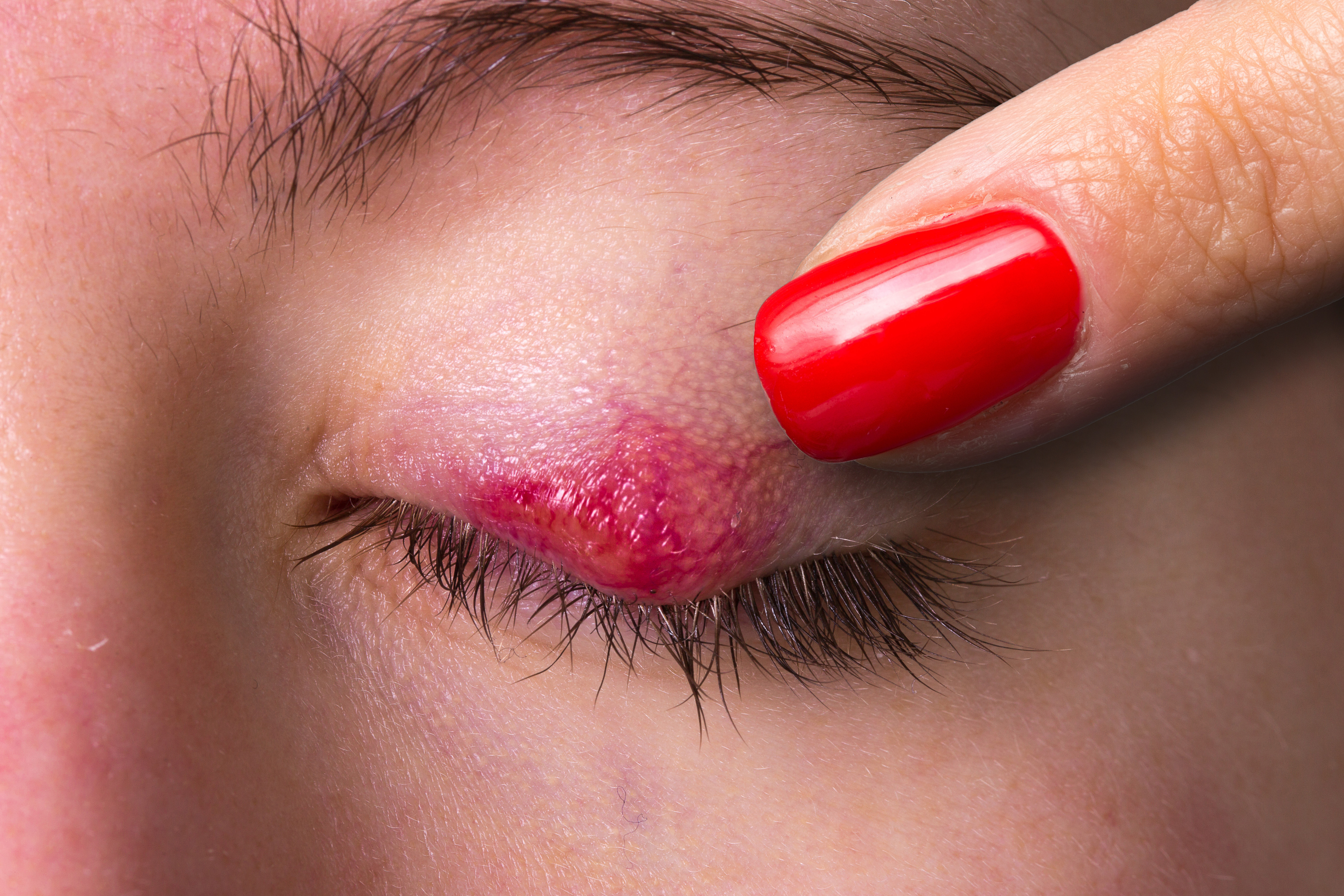 3. البَرَدَة أو الكالازيون (Chalazion)