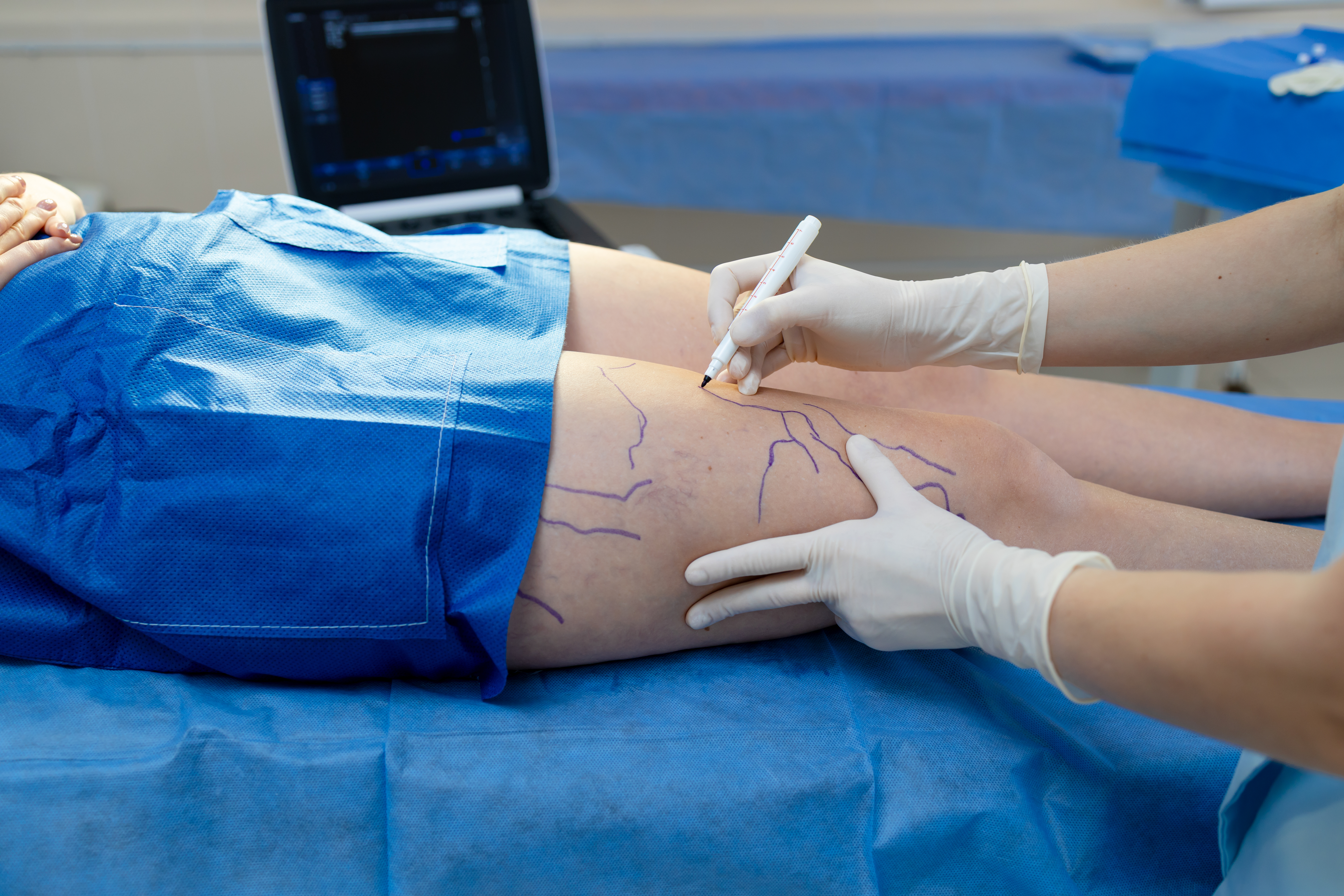 علاج مرض الدوالي