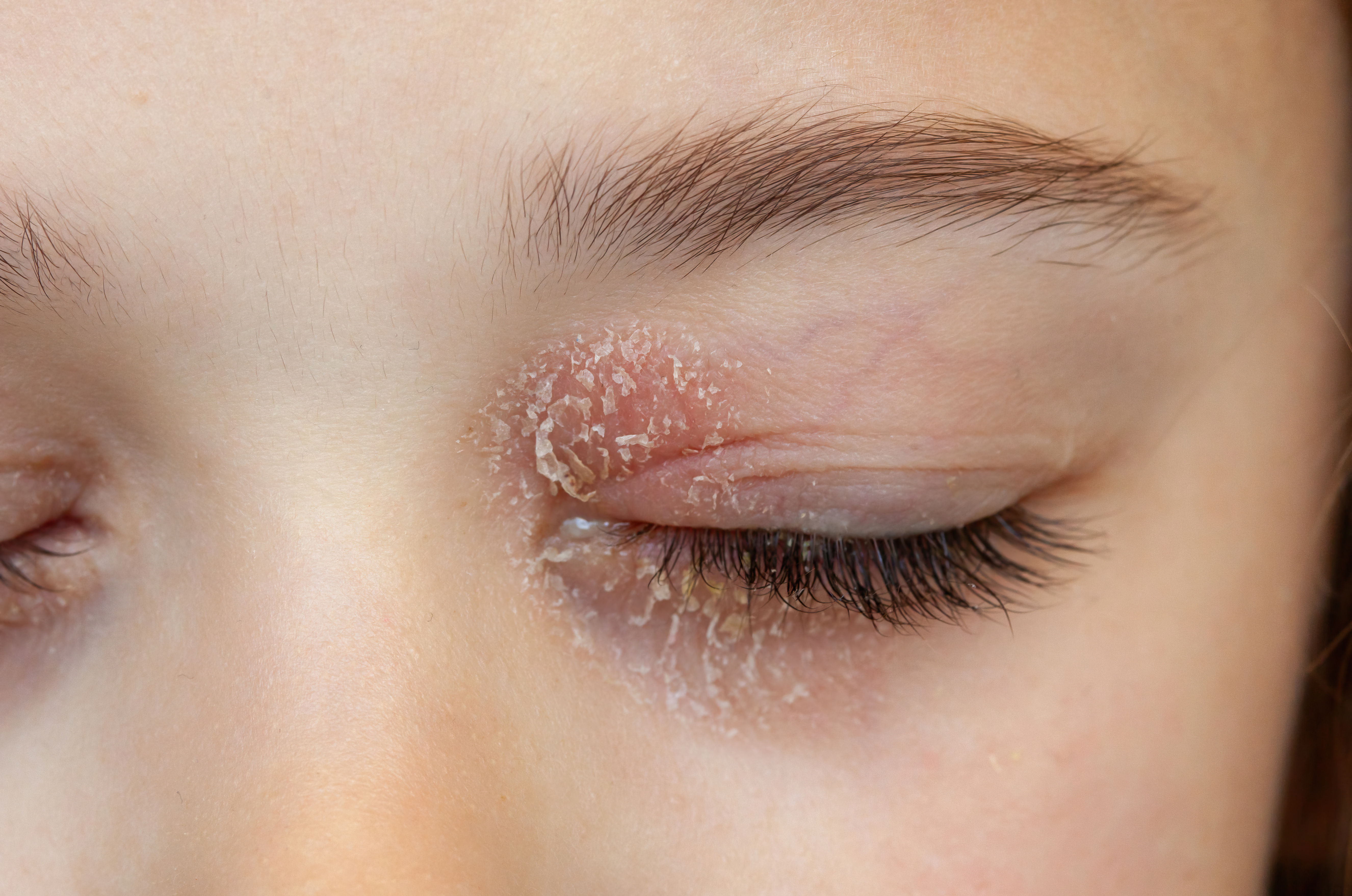 7. التهاب جلد الجفن (Eyelid dermatitis)
