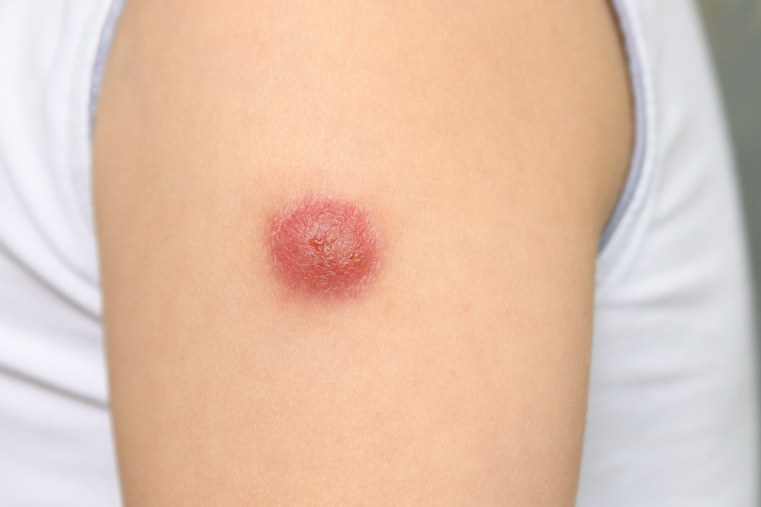 شكل الورم الشحمي وحجمه