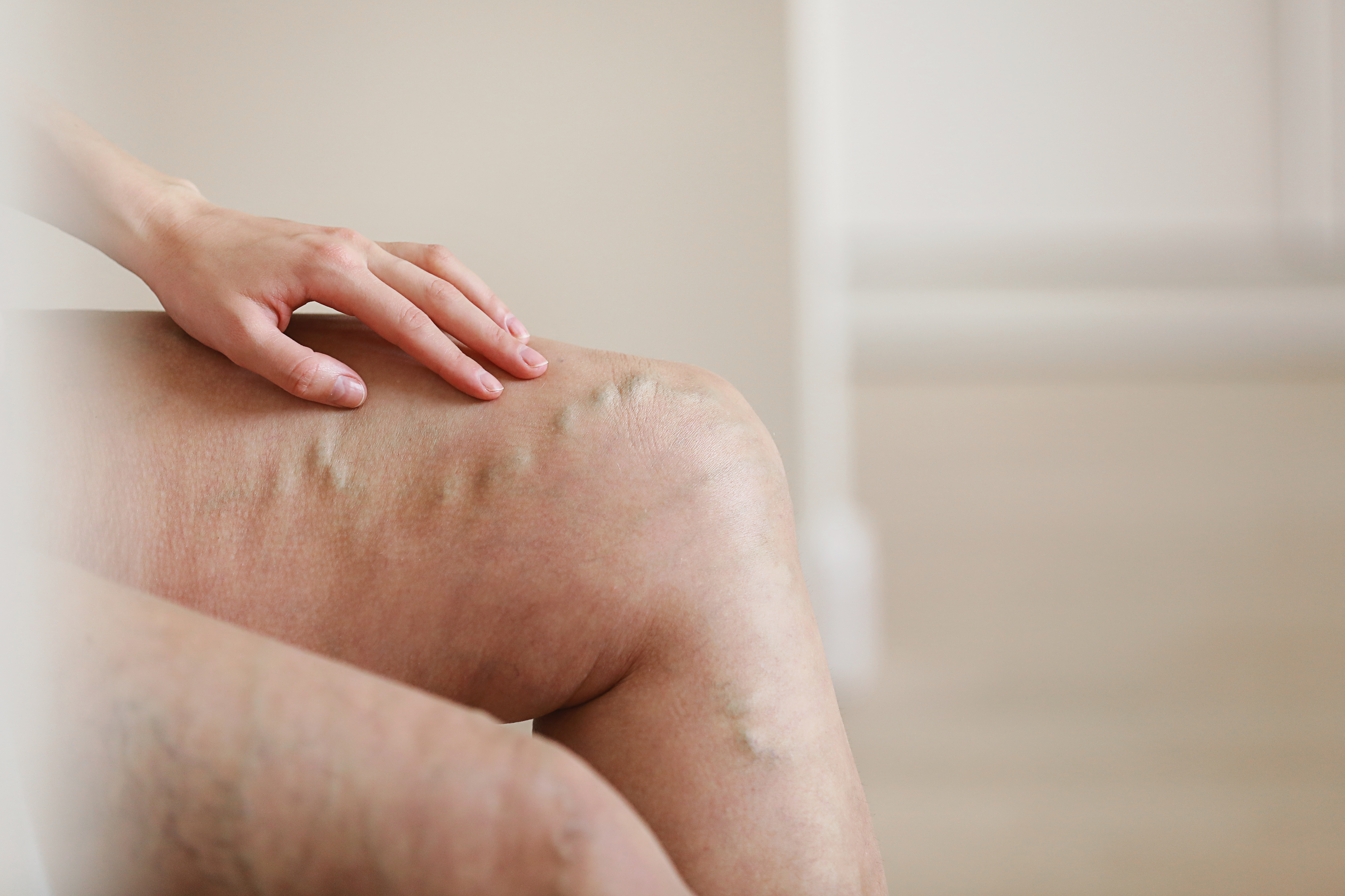 مضاعفات مرض الدوالي