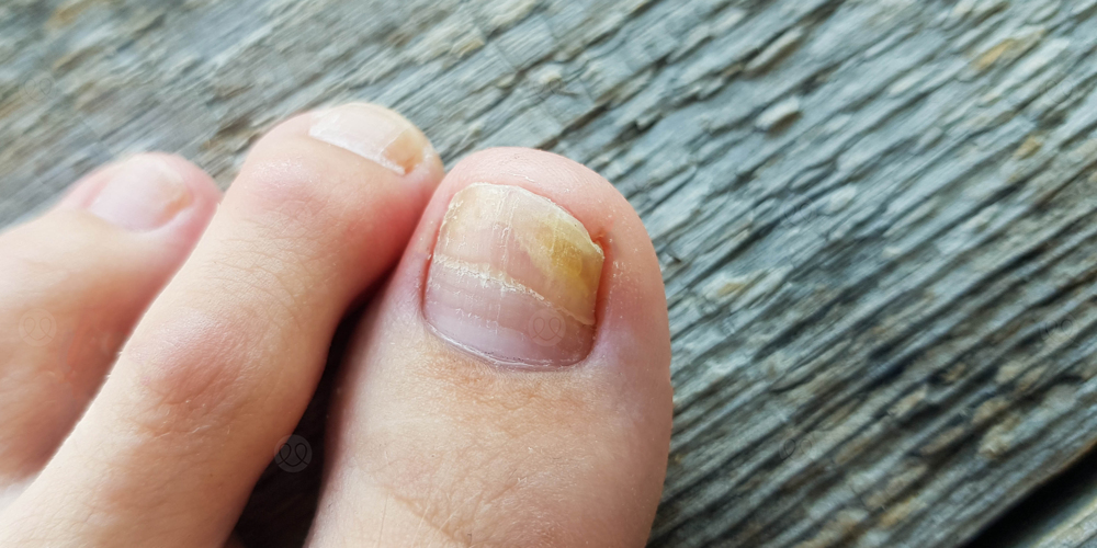 فطريات الجلد