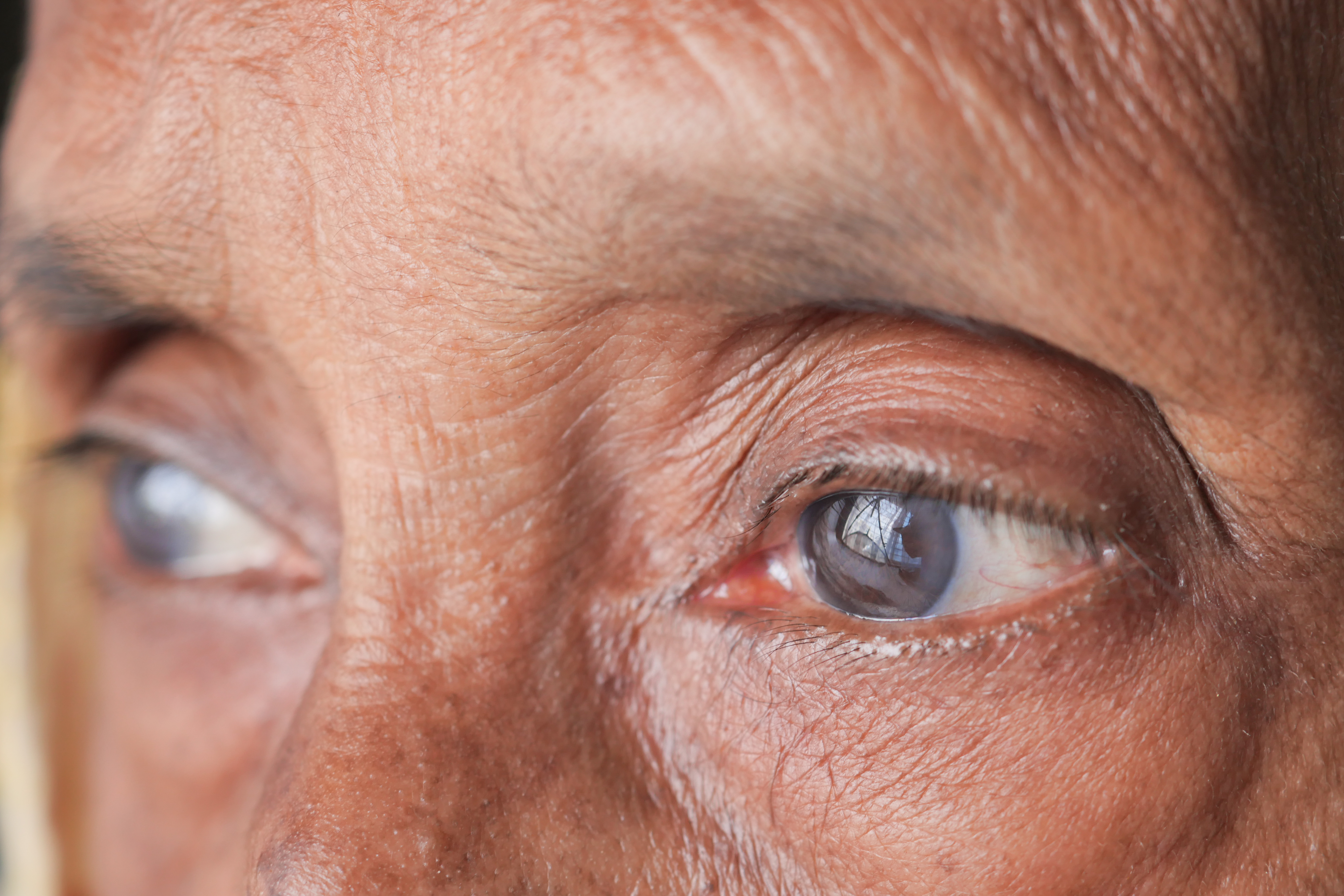 1. إعتام عدسة العين (Cataract)