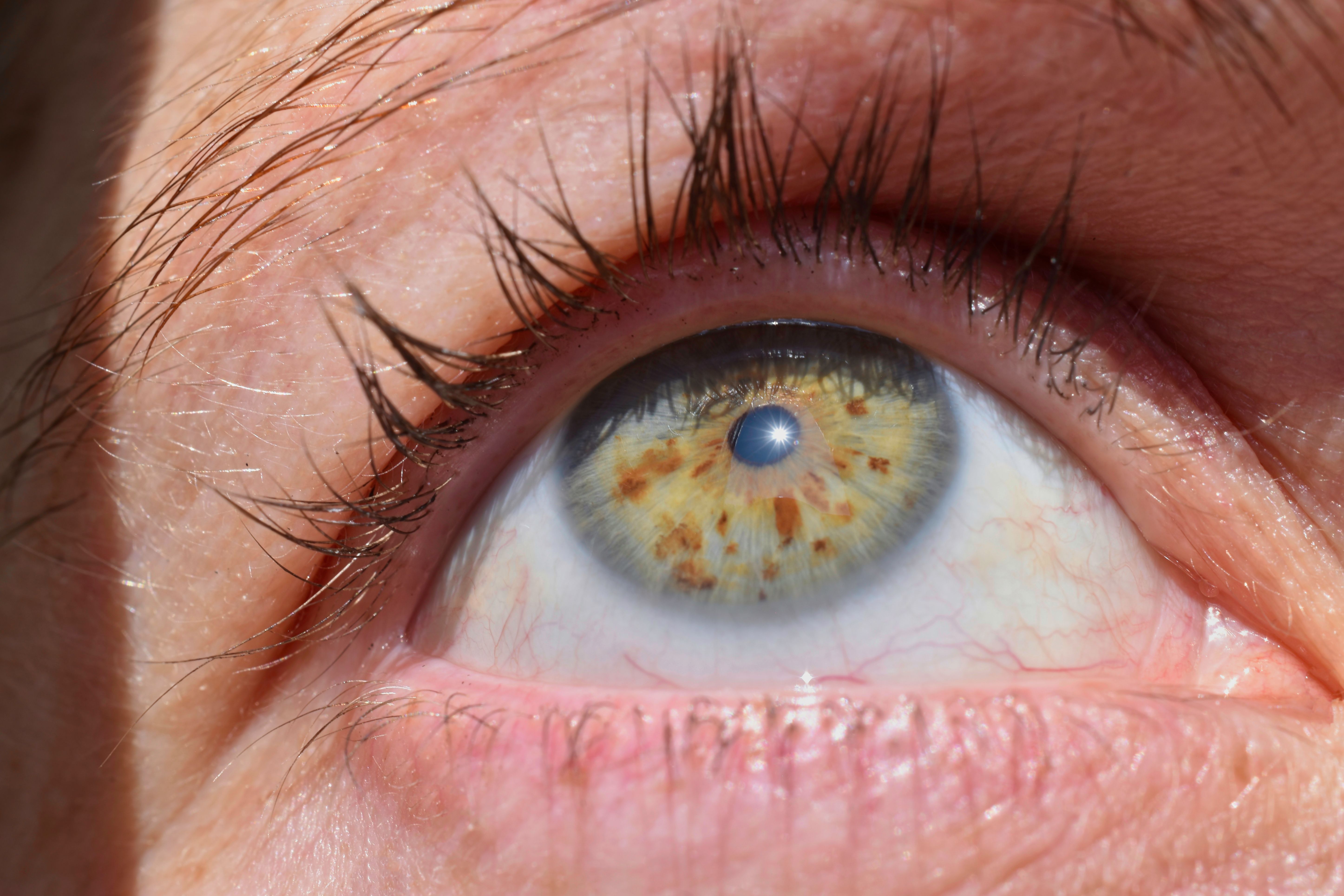 أمراض العيون بالصور: كل ما تحتاج معرفته