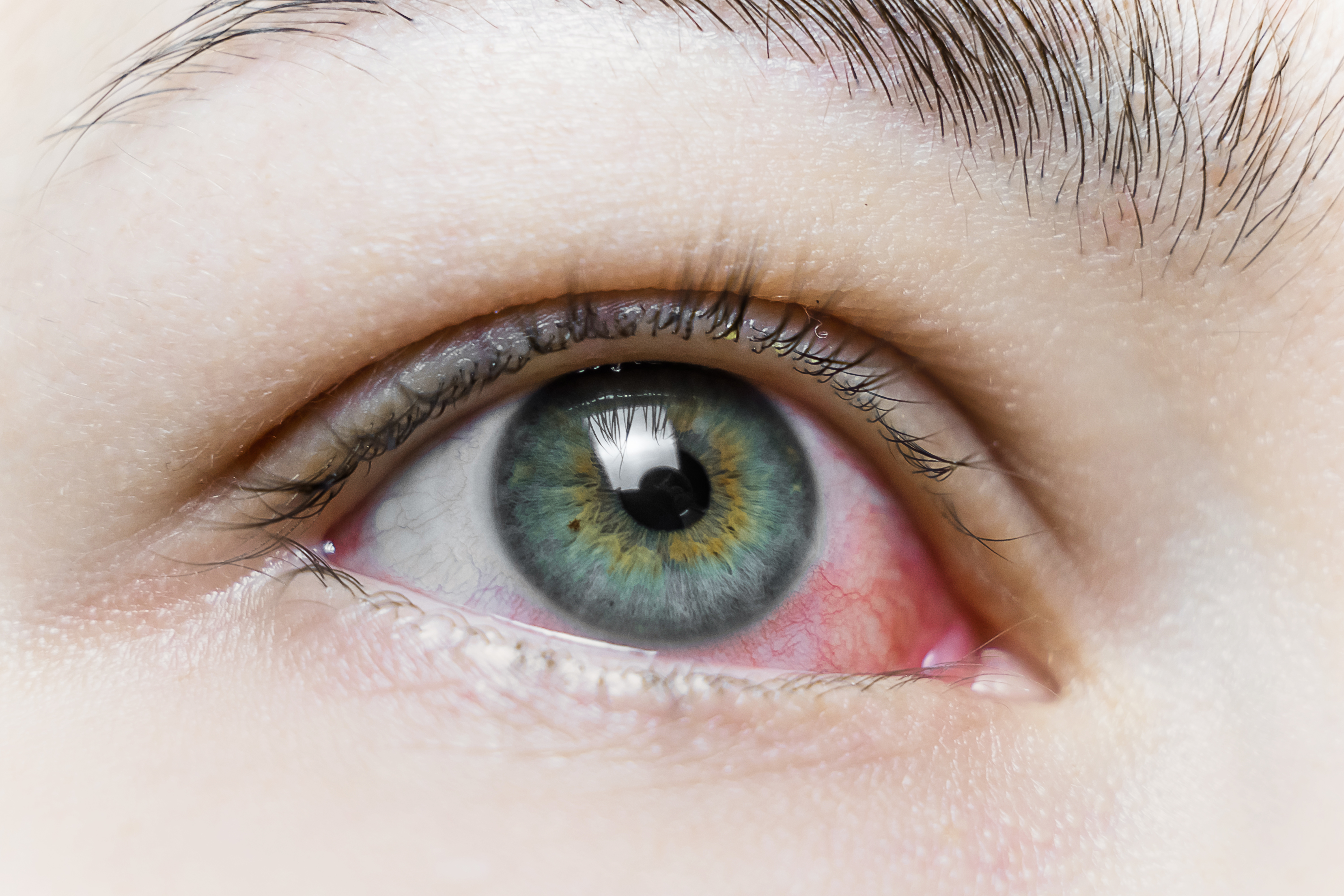 5. متلازمة جفاف العين (Dry eye syndrome)