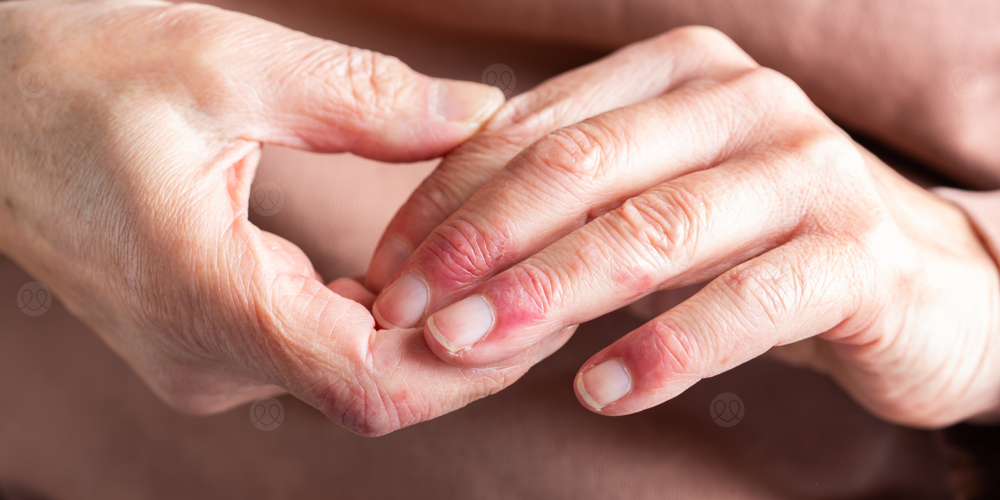 التهاب حول الظفر