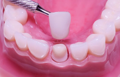 Dental restoration for children