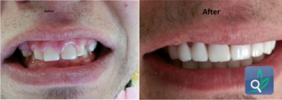 اعراض كورونا للاطفال