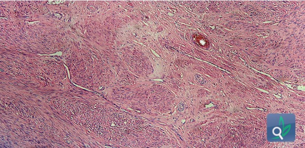 هل يستطيع المصاب بمتلازمة داون الزواج والانجاب
