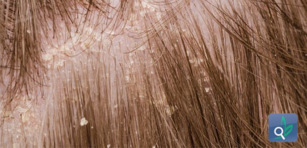 تغذية فروة الرأس