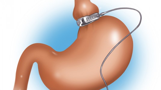 blank-744-1 ربط البطن بعد الولادة