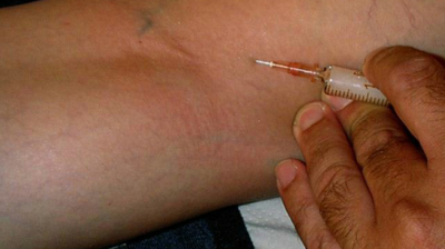 التهاب الجلد الدوالي Varicose Dermatitis اسباب اعراض الطبي