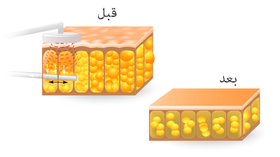 شفط الشحوم