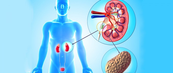 فيتامين د و حصى الكلى