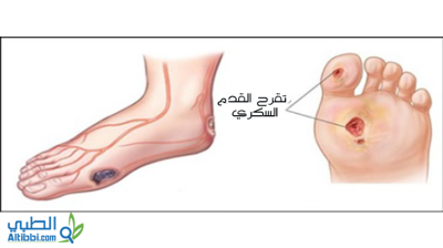 قرحة القدم السكرية