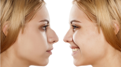 عمليات تجميل الانف