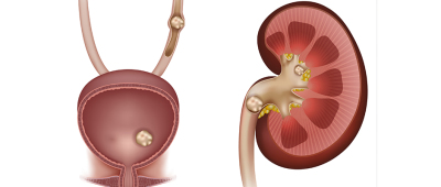 كيف تقلل من احتمالية تكون حصى الكلى و الحالب بطرق طبيعية؟