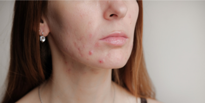 علاج حب الشباب