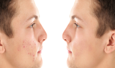 علاج حب الشباب