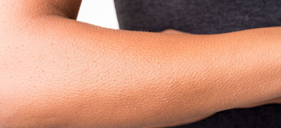 علاج جلد الدجاجة