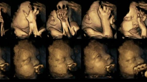 مخاطر تدخين الأم خلال الحمل يظهر على وجوه الأجنّة
