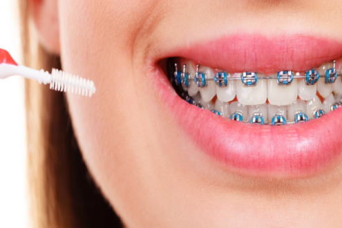 تقويم الأسنان امور يجب تجنبها واسباب تركيب التقويم الطبي