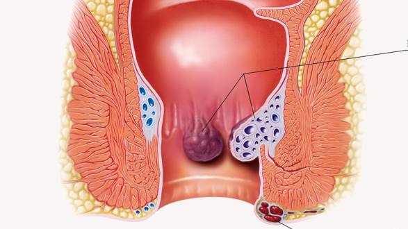 علاج البواسير الخارجية مدة العلاج وطرق الوقاية الطبي